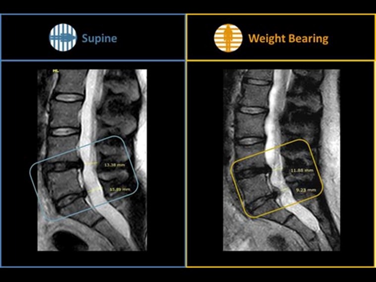 Disc herniation and changes