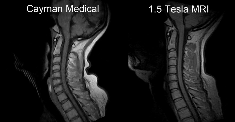 Same patient - scanned first in a 1.5T scanner (right) and then with our open MRI scanner (left)