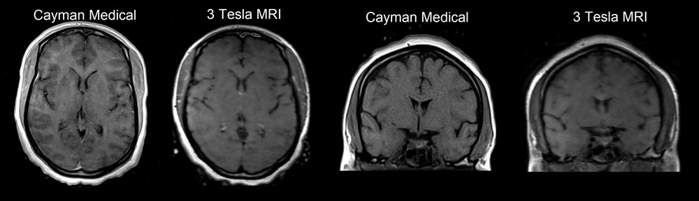Same patient - scanned first in a 3T scanner (right) and then with our open MRI scanner (left)