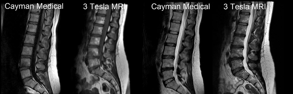 Same patient - scanned first in a 3T scanner (right) and then with our open MRI scanner (left)